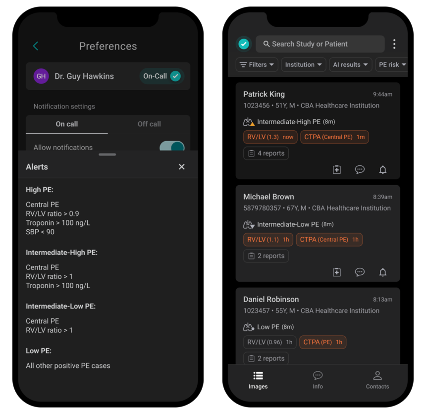 How Aidoc’s New Automated Dynamic Risk Stratification Feature Benefits PERTs – Healthcare AI