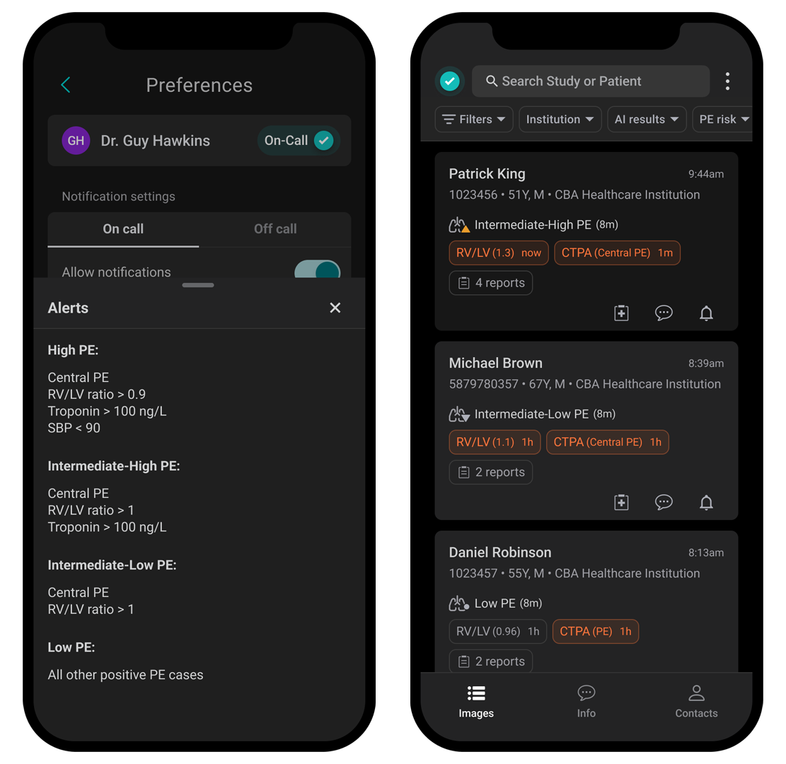 How Aidoc’s New Automated Dynamic Risk Stratification Feature Benefits PERTs – Healthcare AI